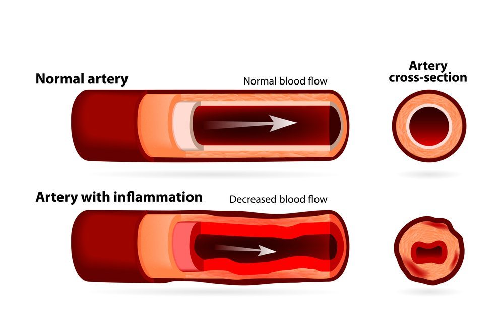 Vasculitis - Litchfield Park Dermatologist | Clear Sky Dermatology